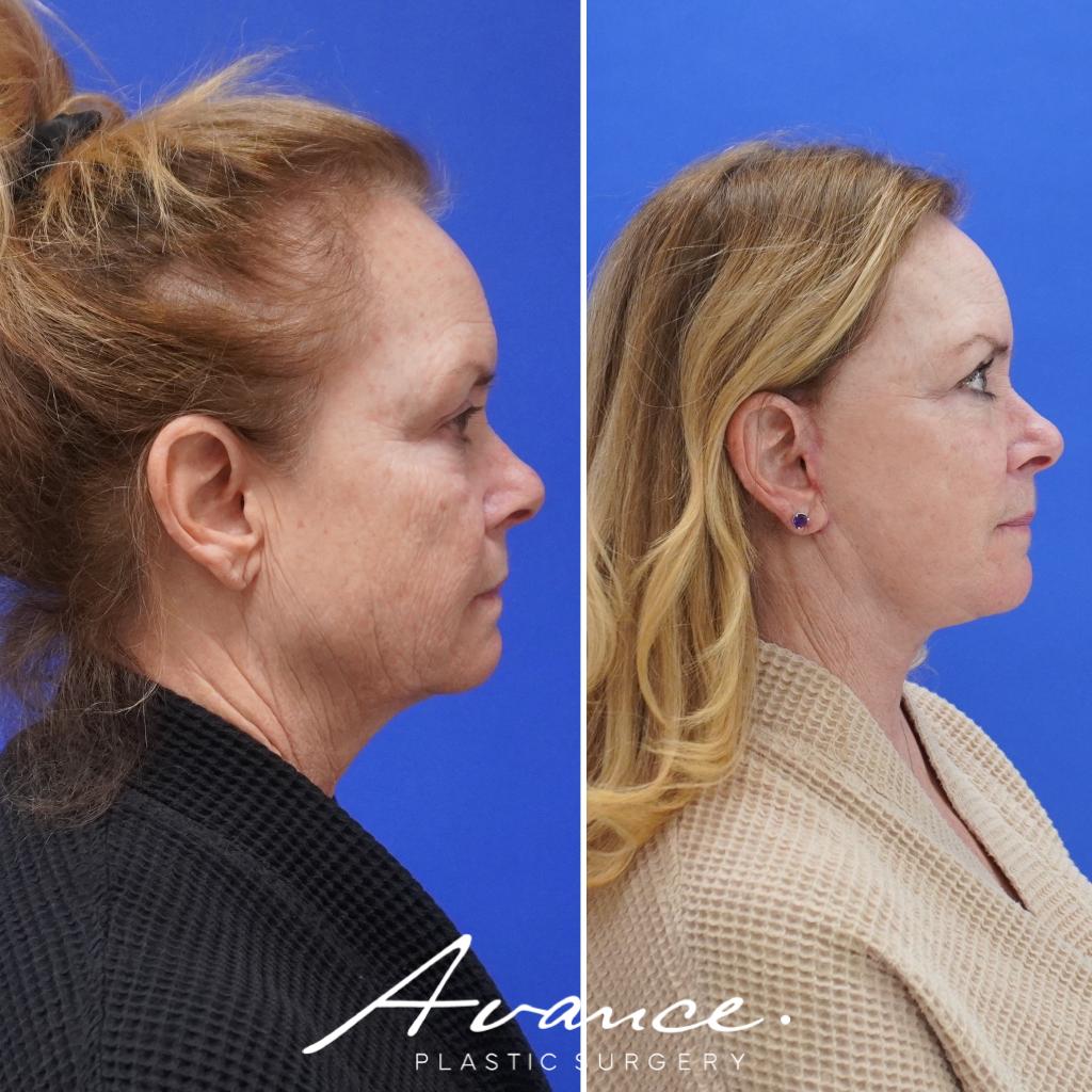 Before and After - Mini Face/Necklift