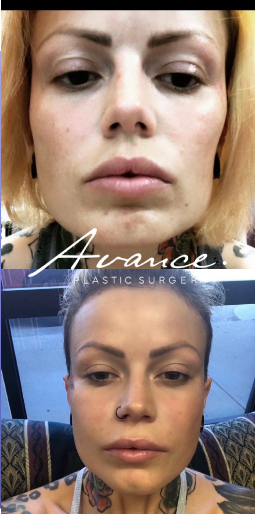 Before and After - Transferencia de grasa facial