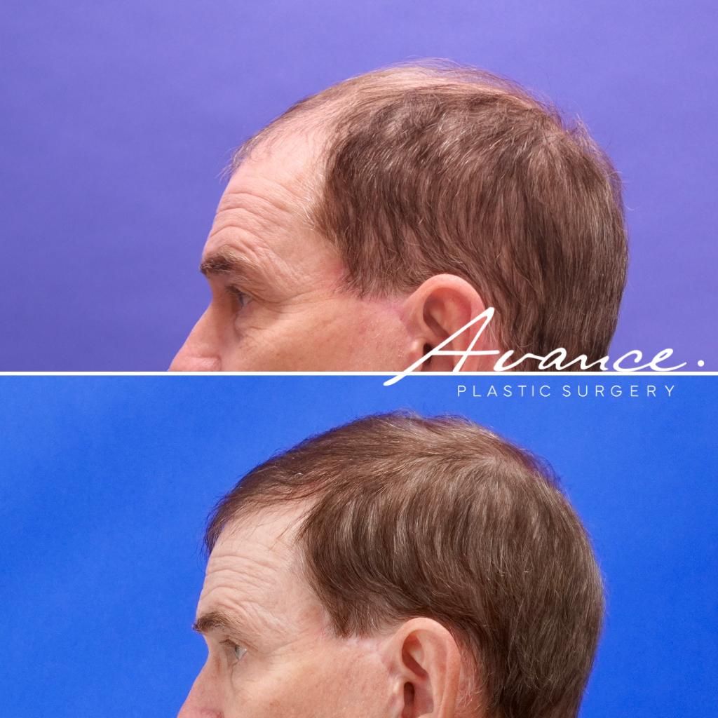 Before and After - Hair Transplant