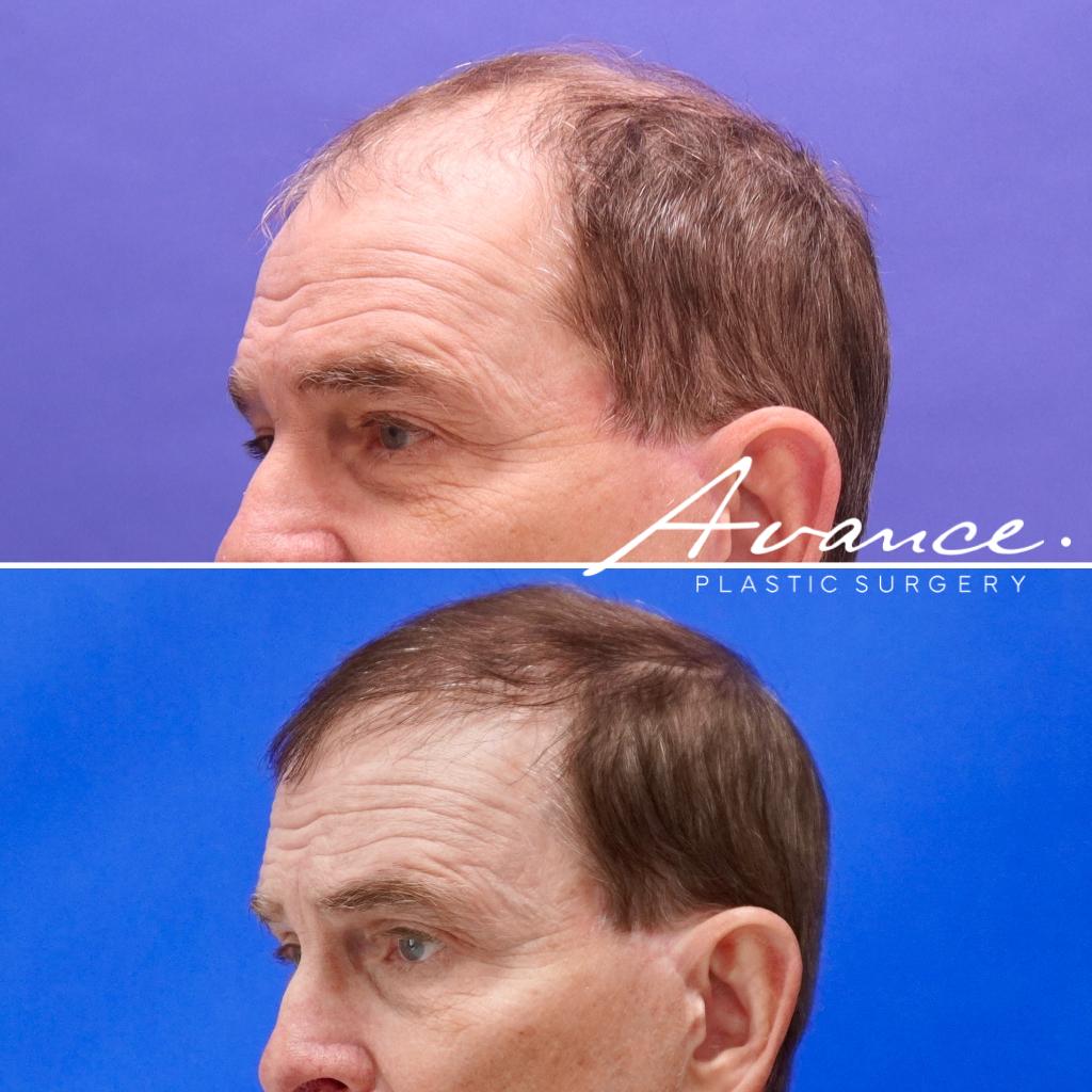 Before and After - Hair Transplant
