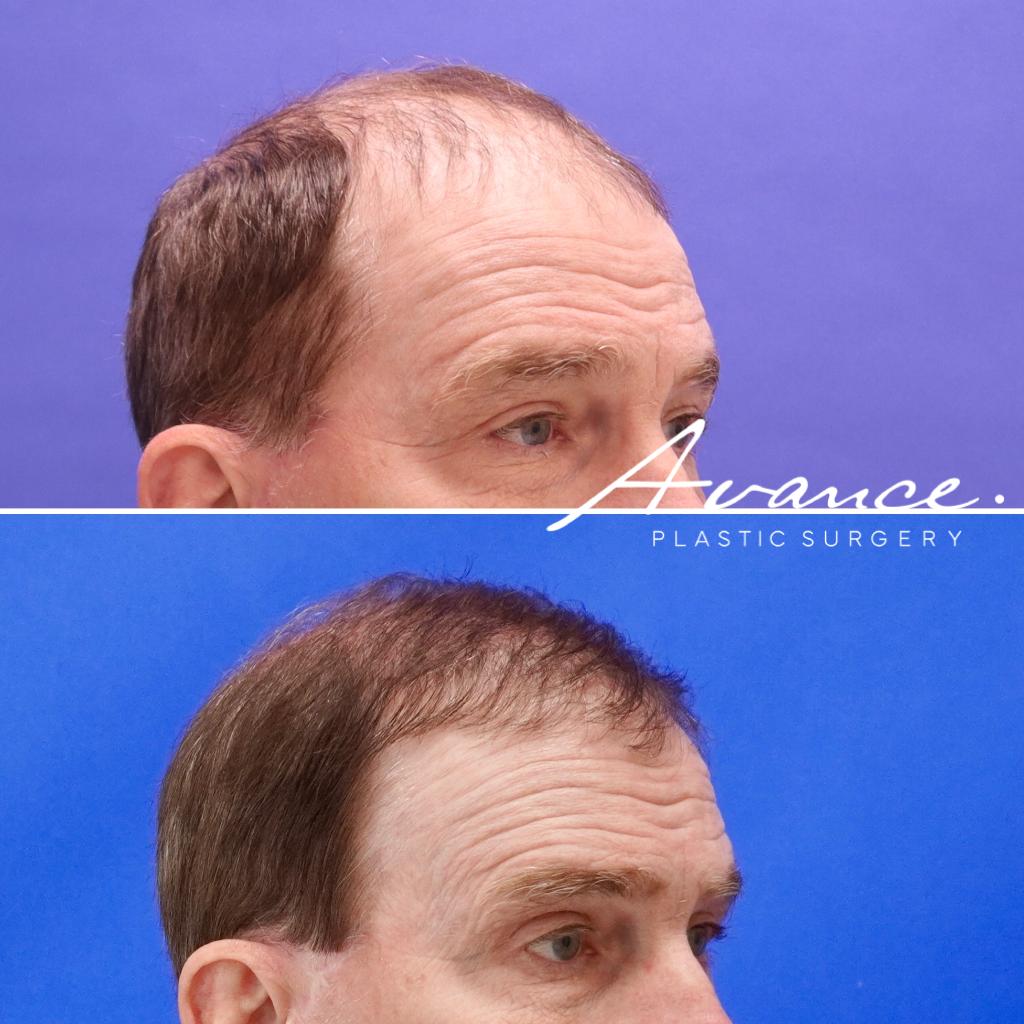 Before and After - Hair Transplant