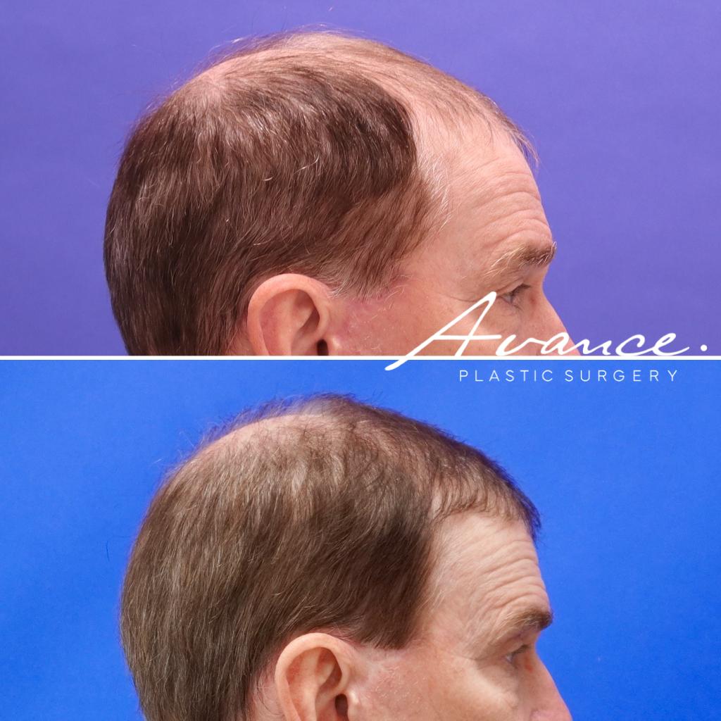 Before and After - Hair Transplant