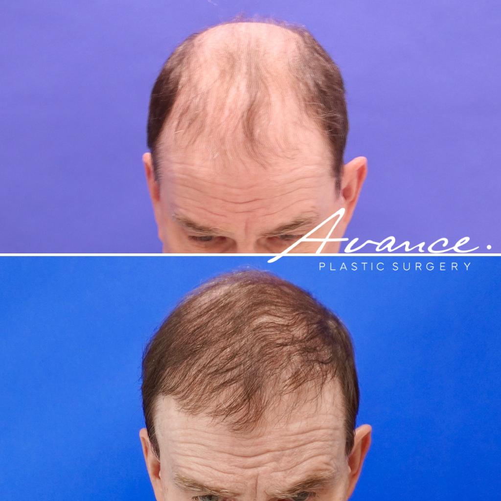 Before and After - Hair Transplant