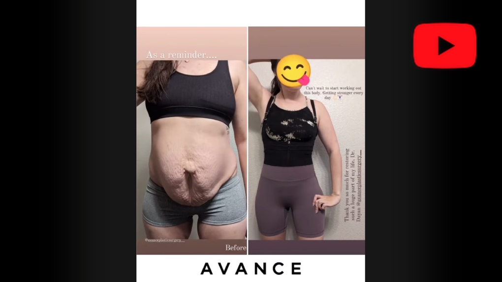 YouTube video titled 29 Year Old Patient Before And After Tummy Tuck & Liposuction | Avance Plastic Surgery Institute