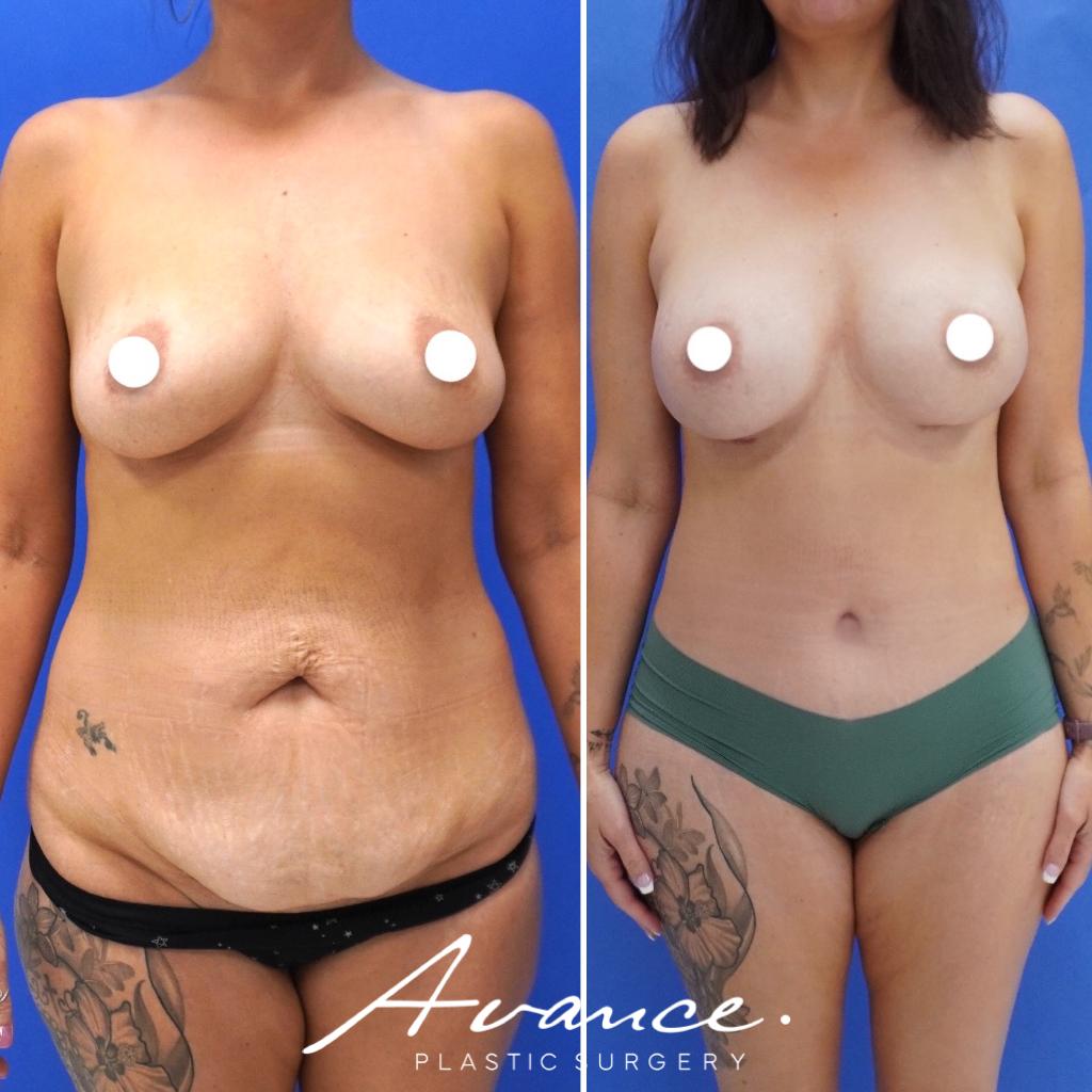 Before and After - Mommy Makeover