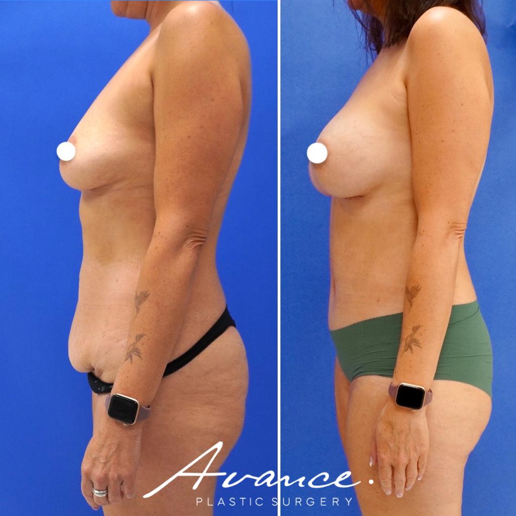 Before and After - Mommy Makeover
