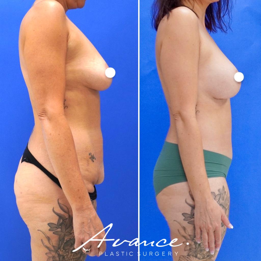 Before and After - Mommy Makeover