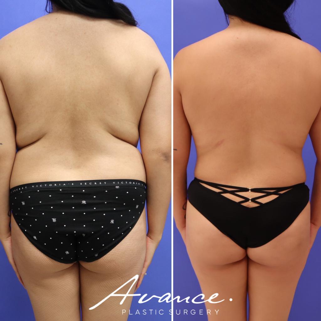 Before and After - Mommy Makeover