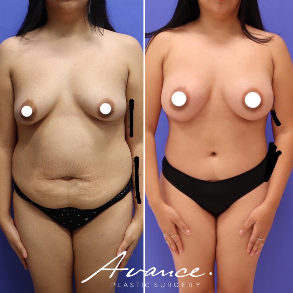 Before and After - Mommy Makeover