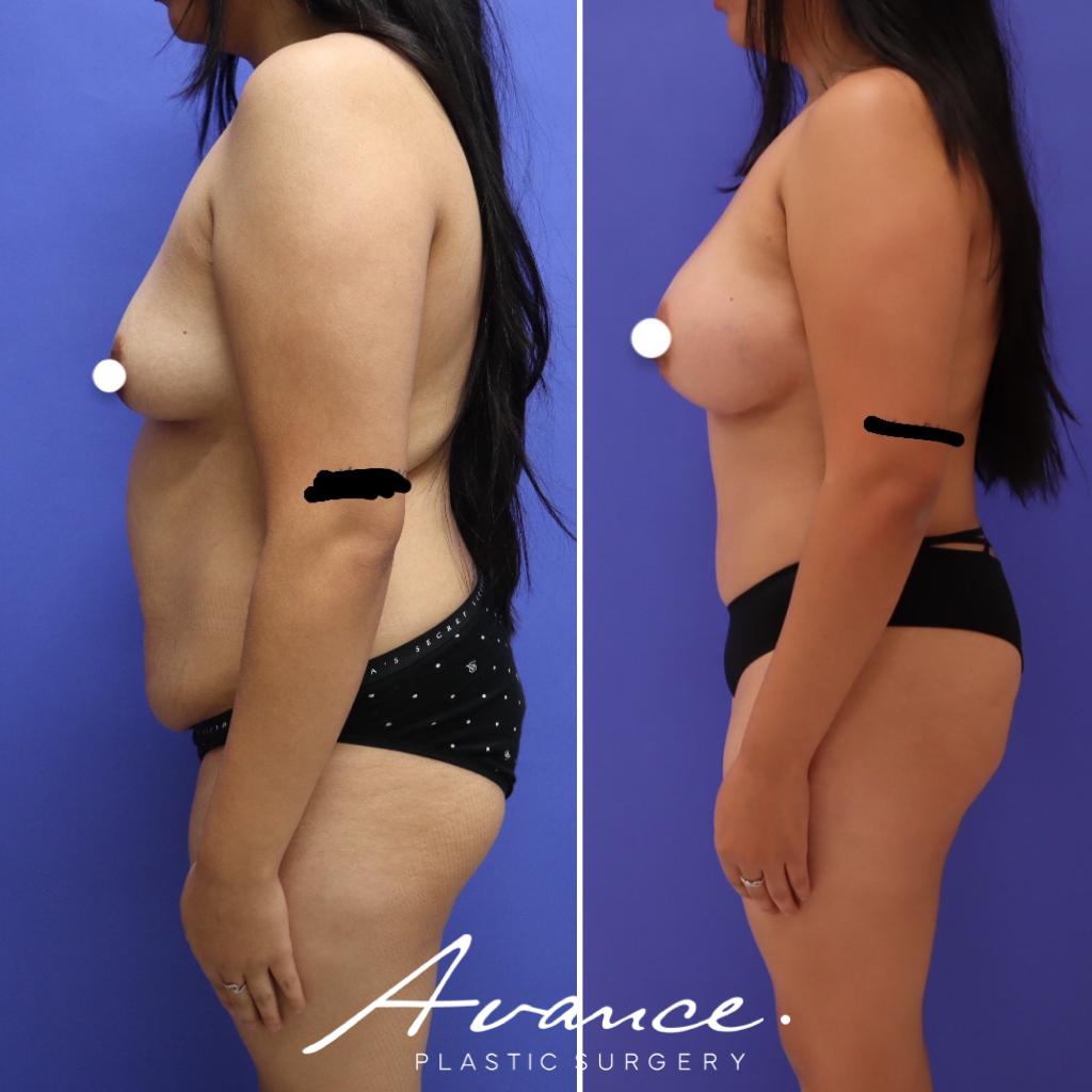 Before and After - Mommy Makeover