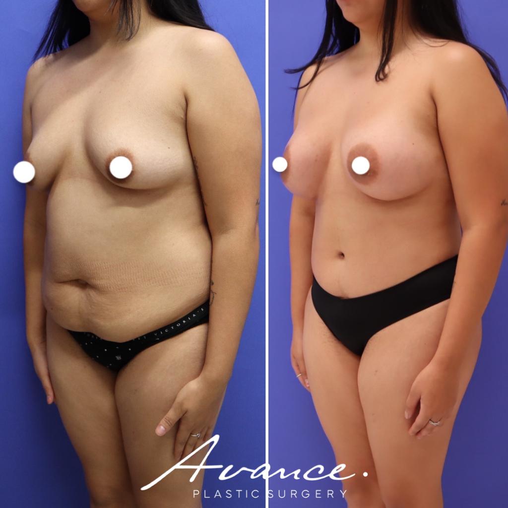 Before and After - Mommy Makeover