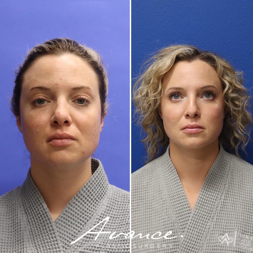 Before and After - Transferencia de grasa facial