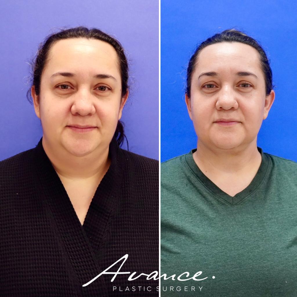 Before and After - Liposucción de cuello con radiofrecuencia FaceTite