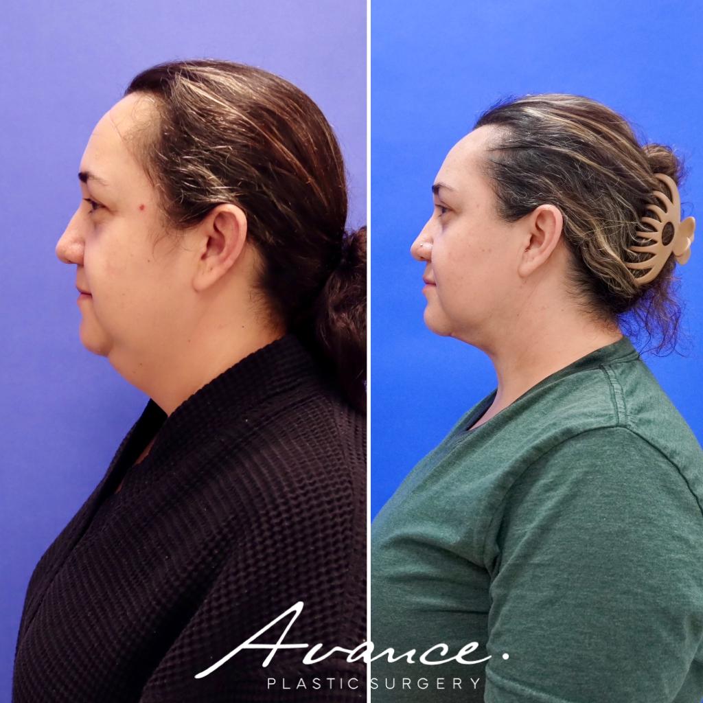 Before and After - Liposucción de cuello con radiofrecuencia FaceTite