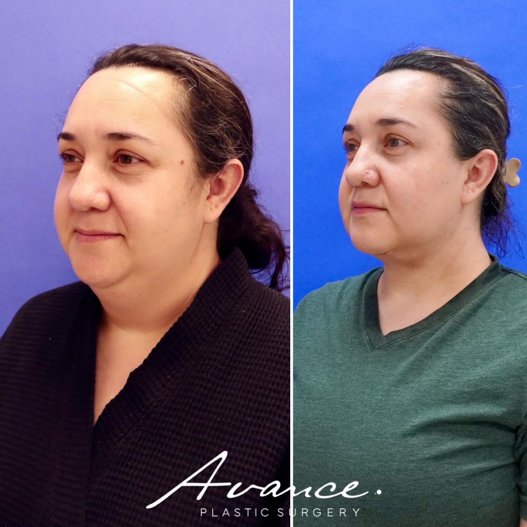 Before and After - Liposucción de cuello con radiofrecuencia FaceTite