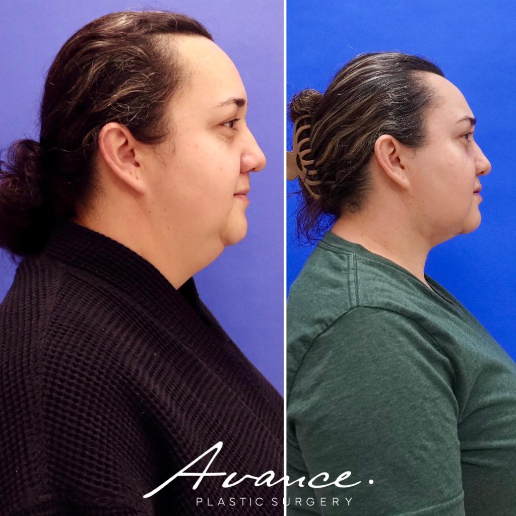 Before and After - Liposucción de cuello con radiofrecuencia FaceTite