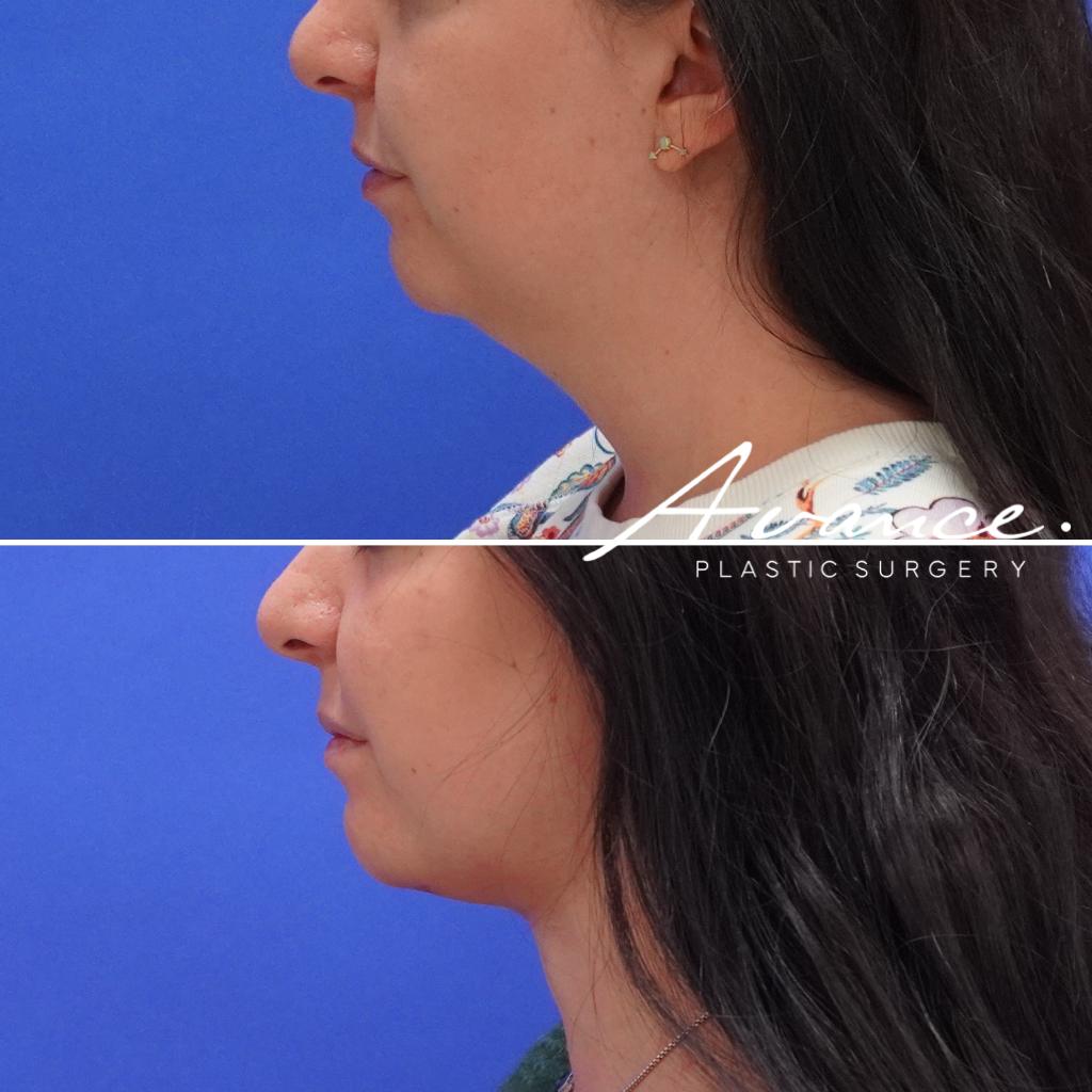 Before and After - Liposucción de cuello con radiofrecuencia FaceTite