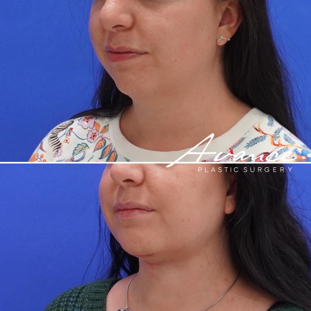 Before and After - Liposucción de cuello con radiofrecuencia FaceTite