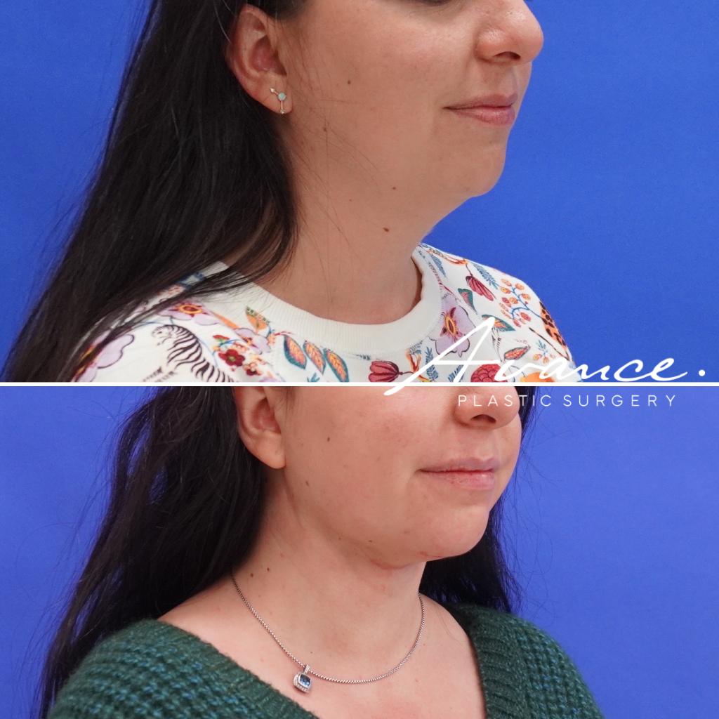 Before and After - Liposucción de cuello con radiofrecuencia FaceTite
