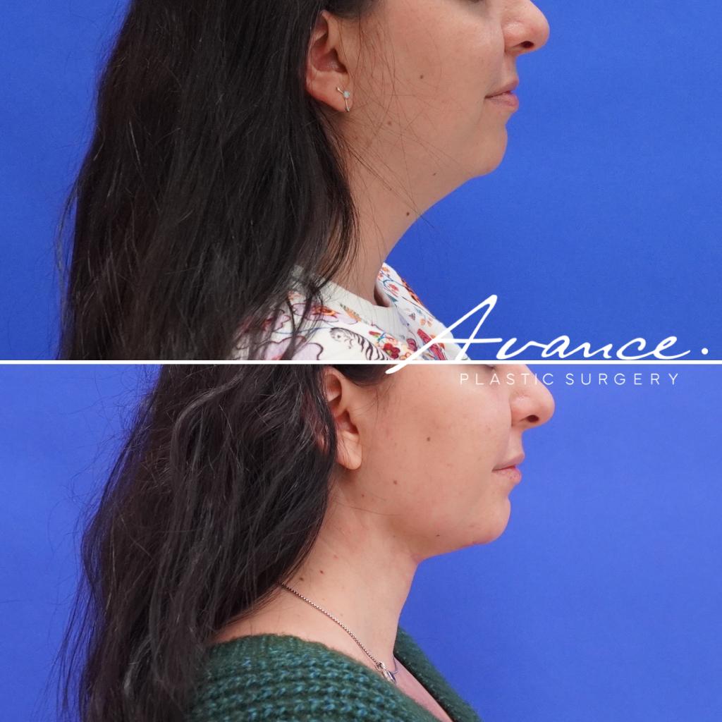Before and After - Liposucción de cuello con radiofrecuencia FaceTite