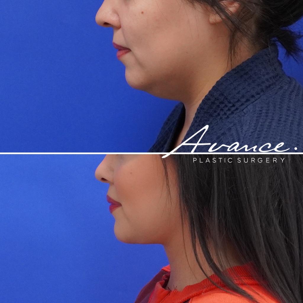Before and After - Liposucción de cuello con radiofrecuencia FaceTite