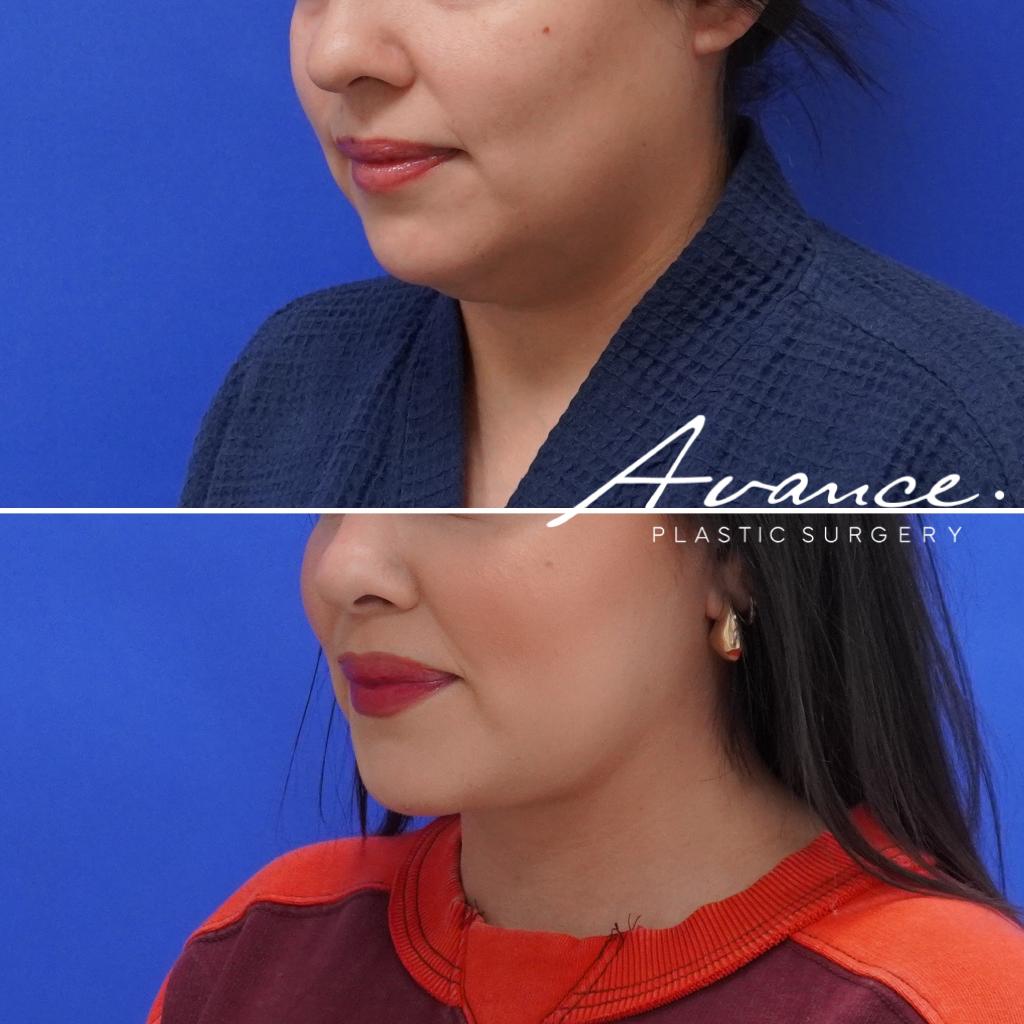 Before and After - Liposucción de cuello con radiofrecuencia FaceTite