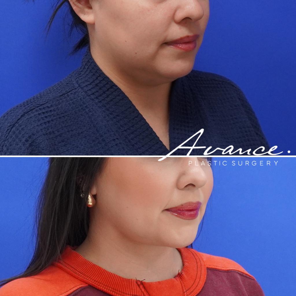 Before and After - Liposucción de cuello con radiofrecuencia FaceTite
