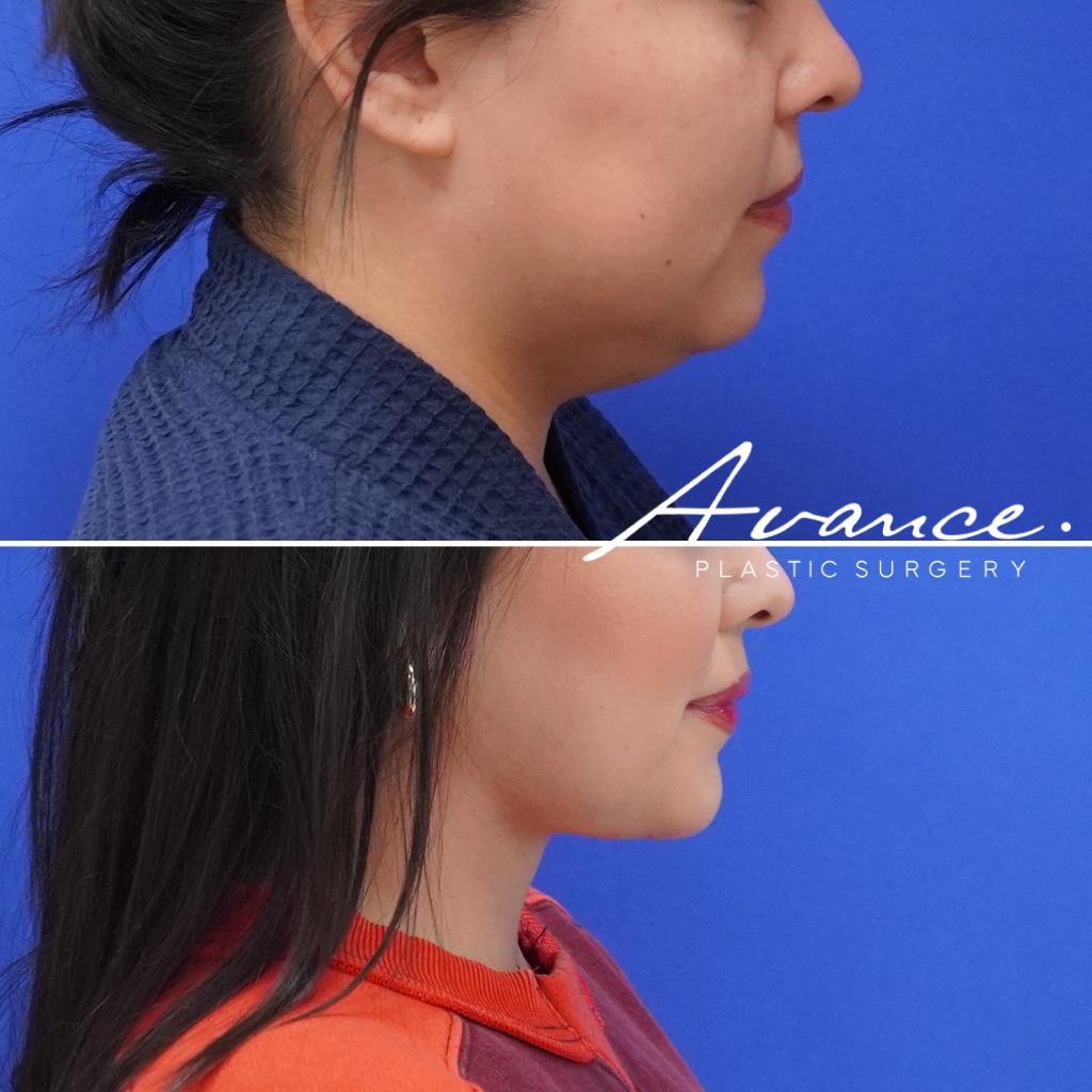 Before and After - Liposucción de cuello con radiofrecuencia FaceTite