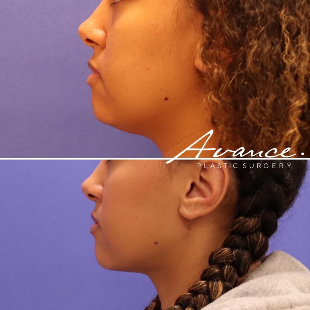 Before and After - Liposucción de cuello con radiofrecuencia FaceTite