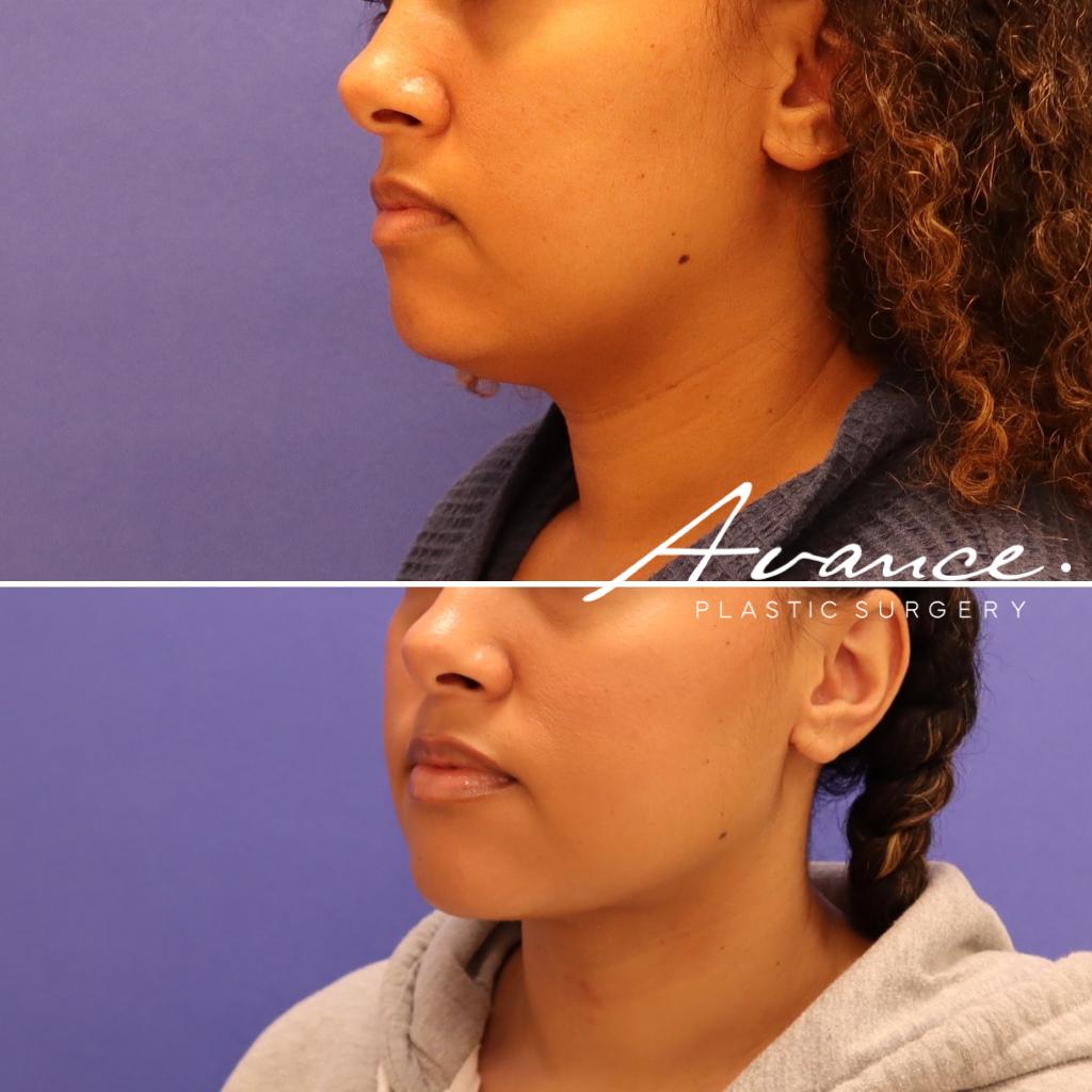 Before and After - Liposucción de cuello con radiofrecuencia FaceTite
