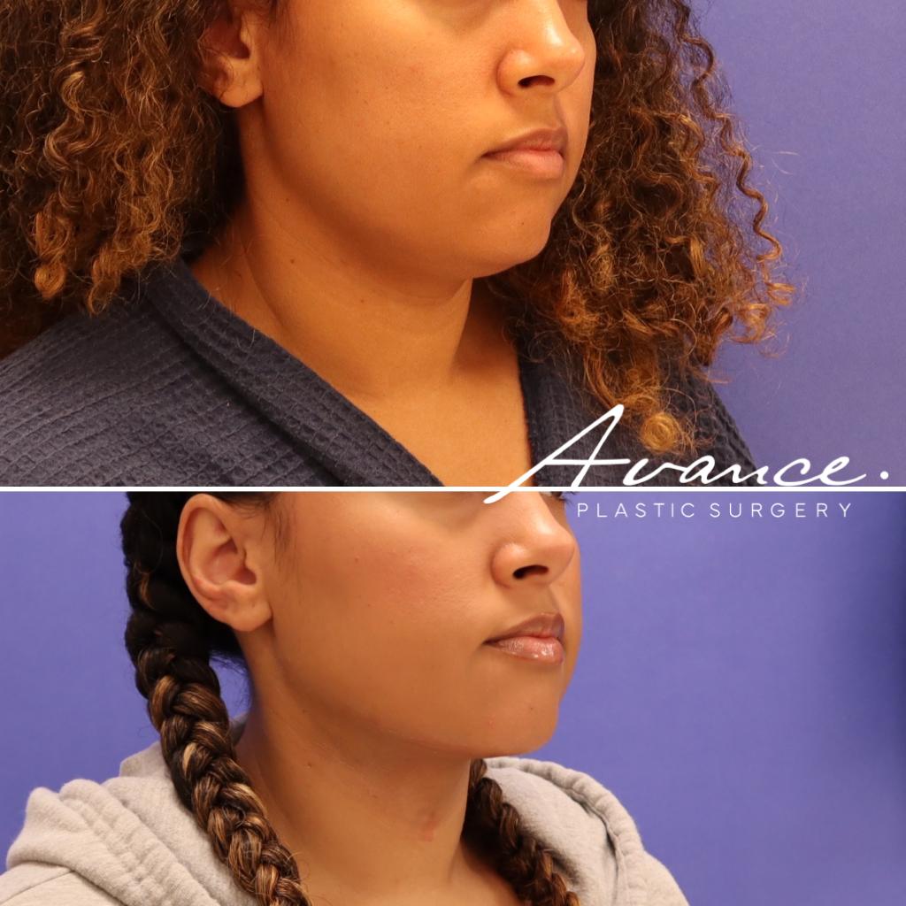 Before and After - Liposucción de cuello con radiofrecuencia FaceTite