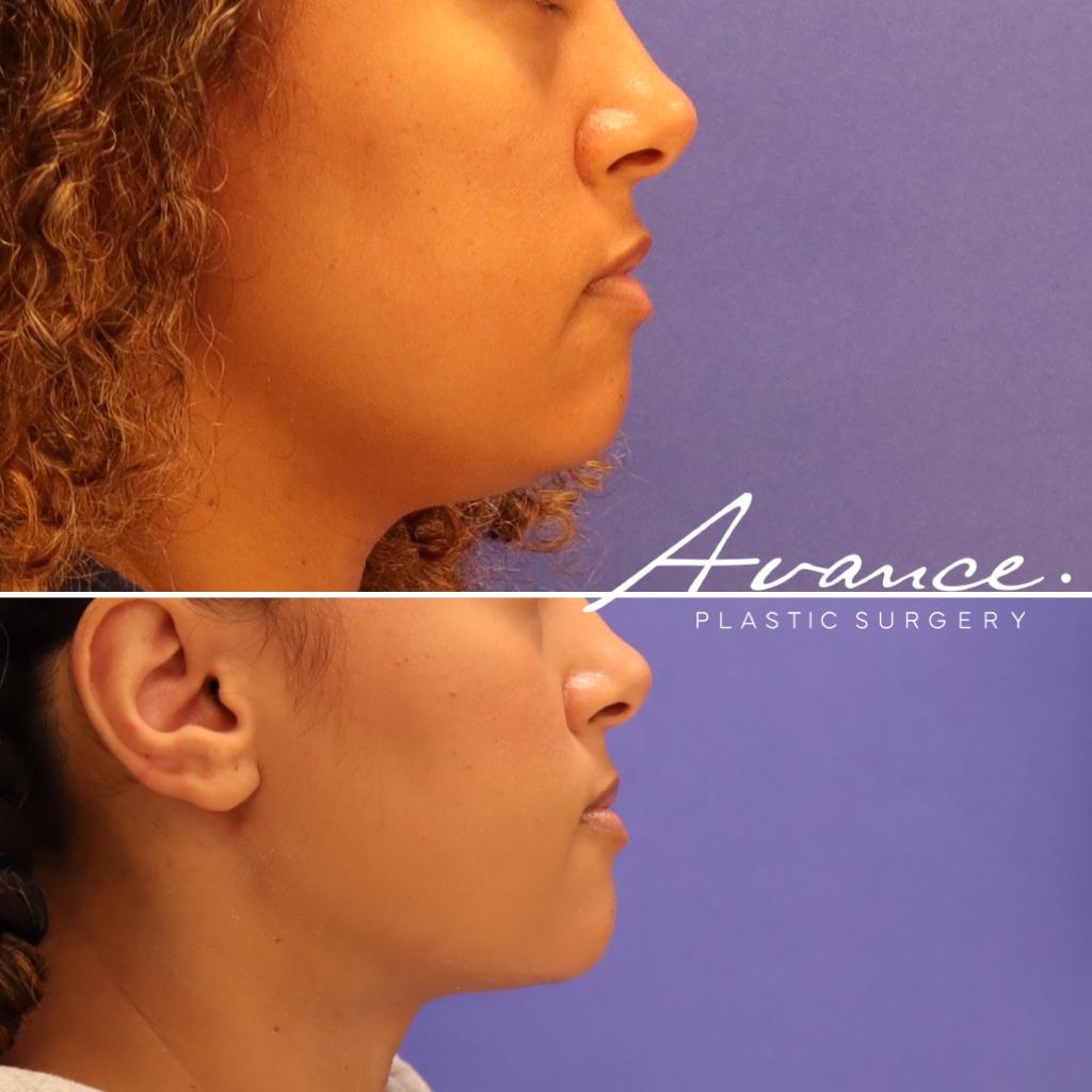 Before and After - Liposucción de cuello con radiofrecuencia FaceTite
