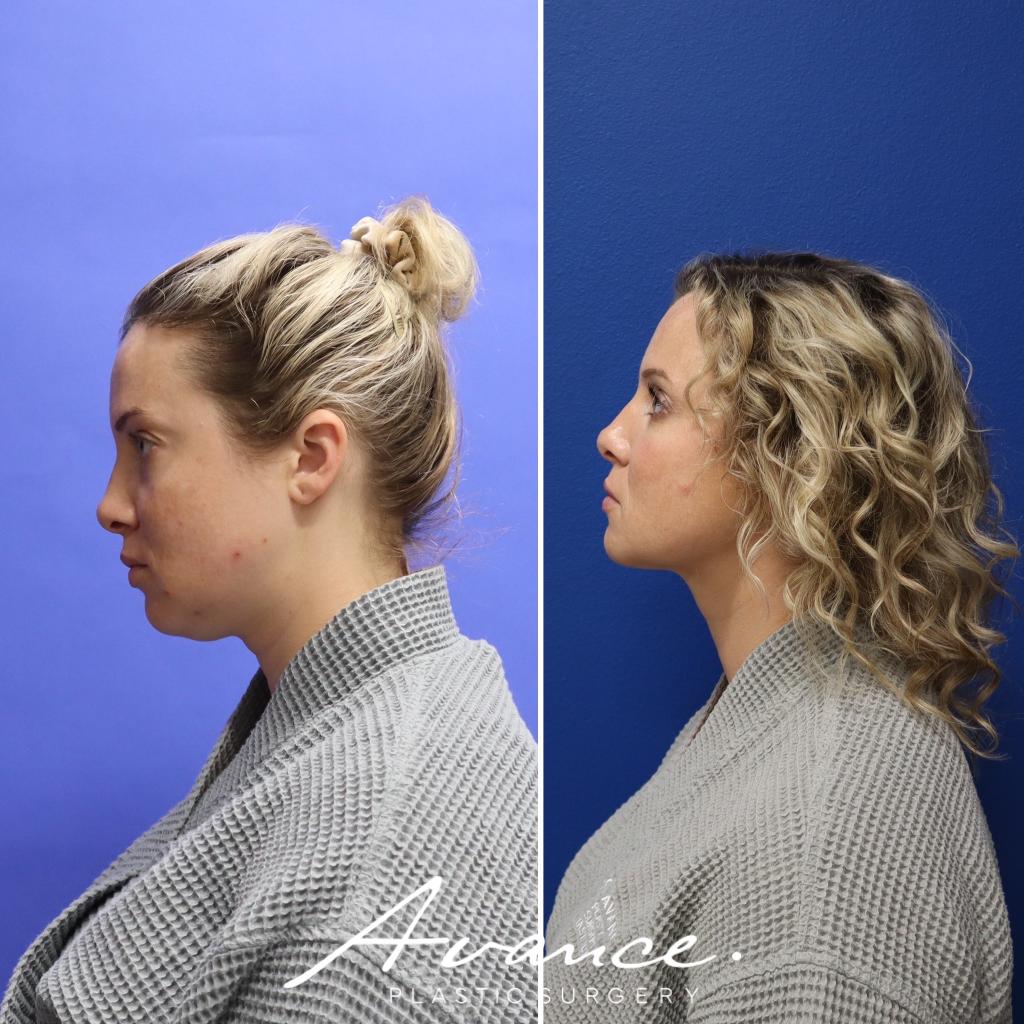 Before and After - Liposucción de cuello con radiofrecuencia FaceTite