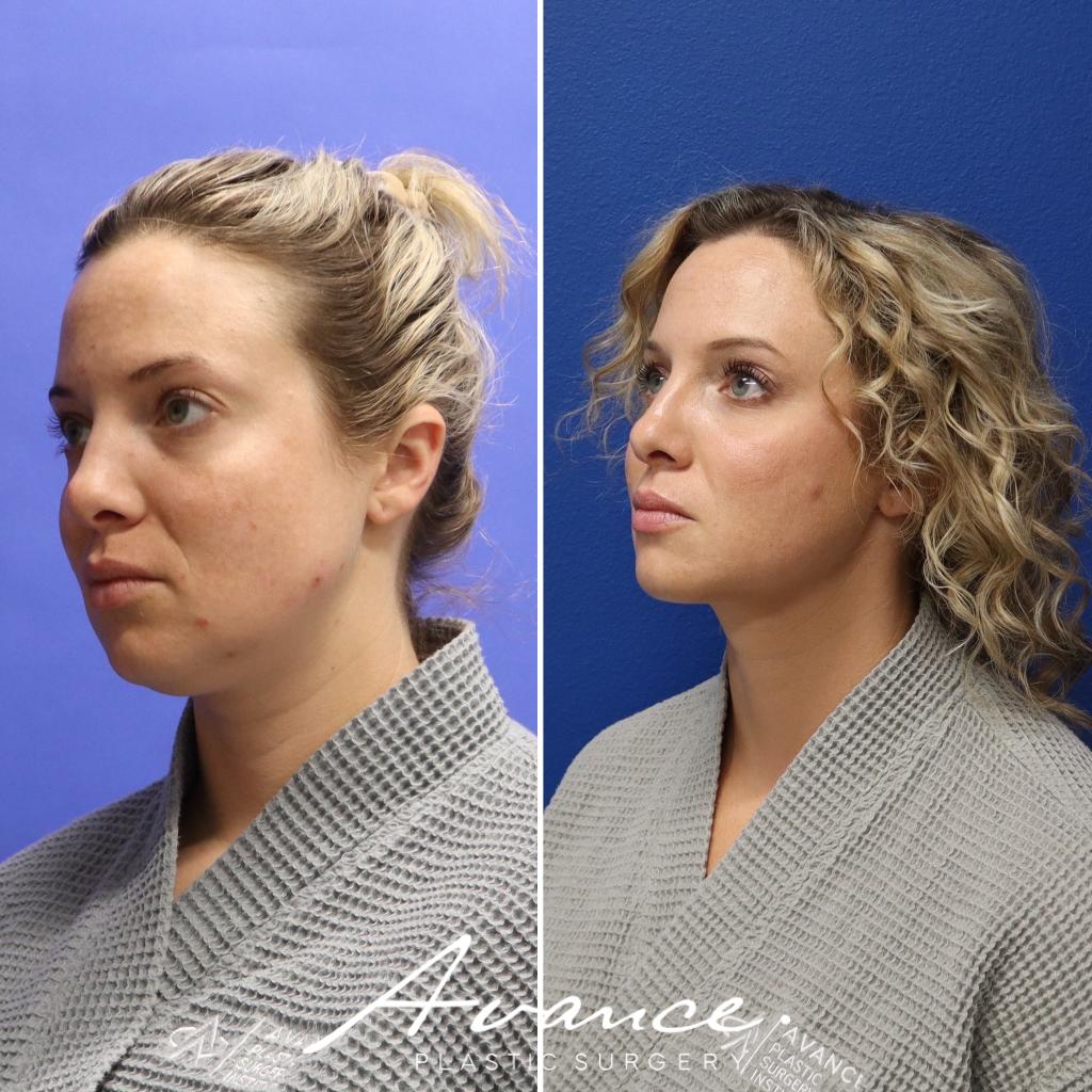 Before and After - Liposucción de cuello con radiofrecuencia FaceTite