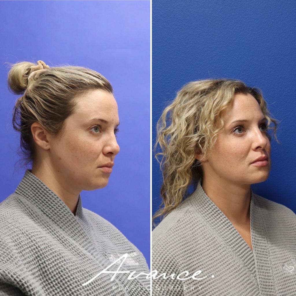 Before and After - Liposucción de cuello con radiofrecuencia FaceTite