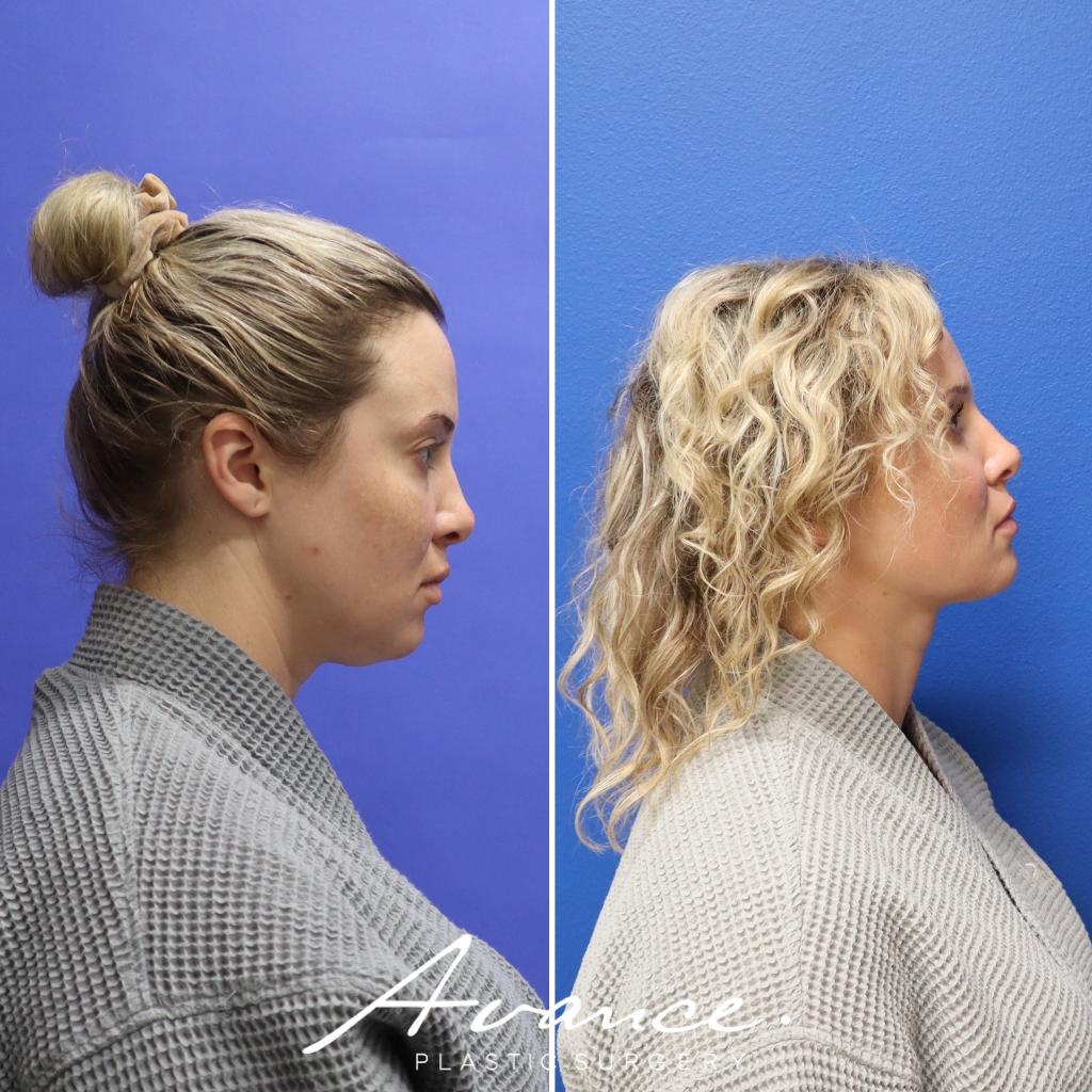 Before and After - Liposucción de cuello con radiofrecuencia FaceTite