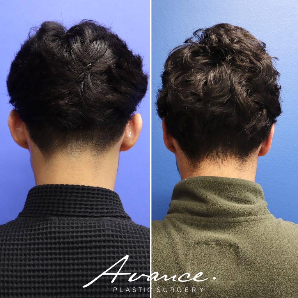 Before and After - Otoplastia