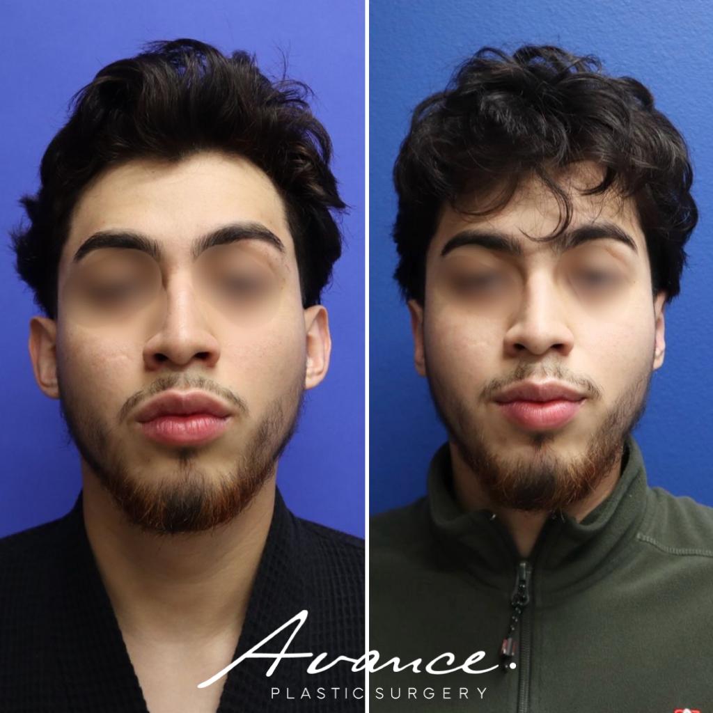 Before and After - Otoplastia