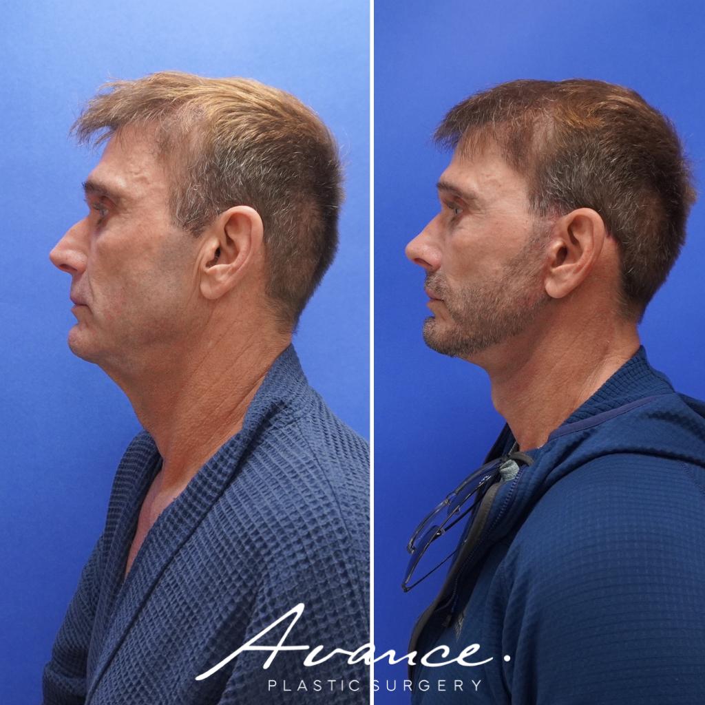 Before and After - Mini Face/Necklift