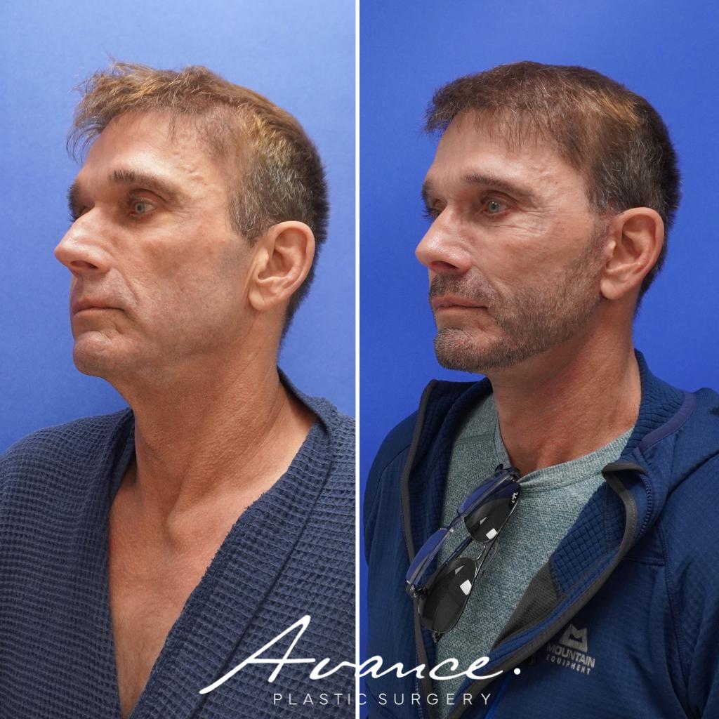 Before and After - Mini Face/Necklift