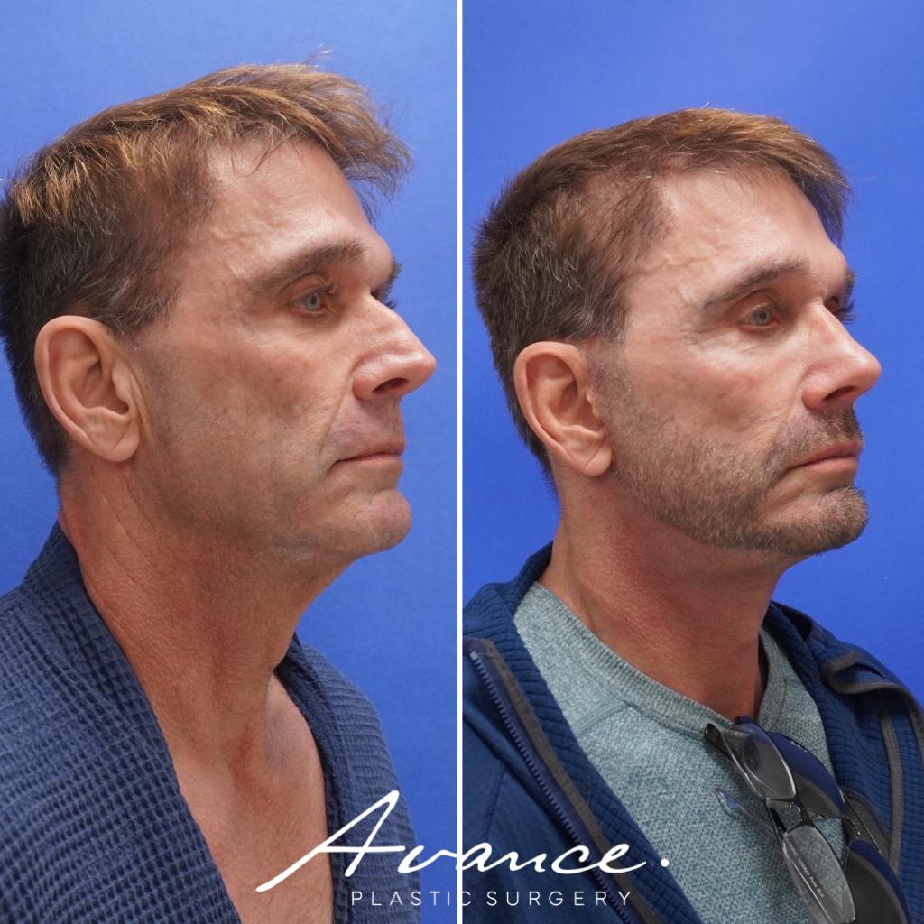 Before and After - Mini Face/Necklift