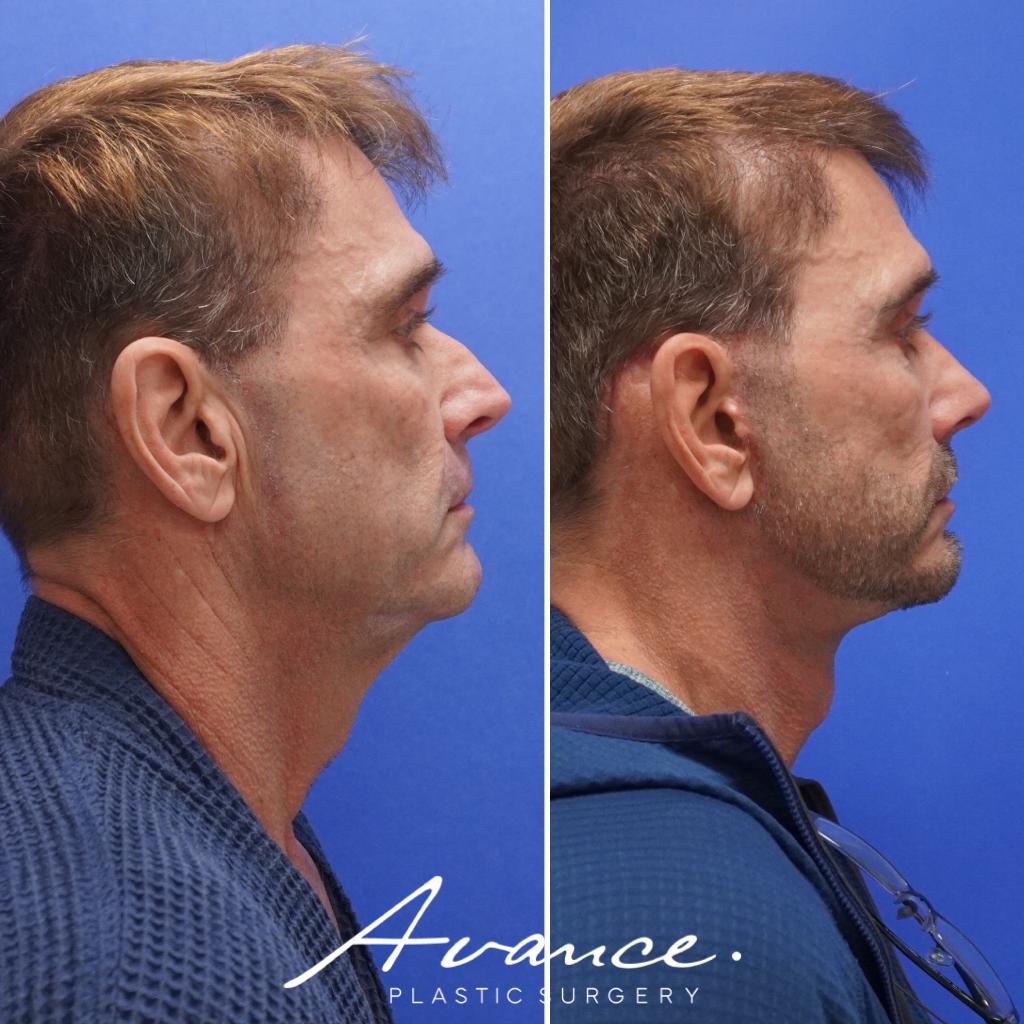 Before and After - Mini Face/Necklift
