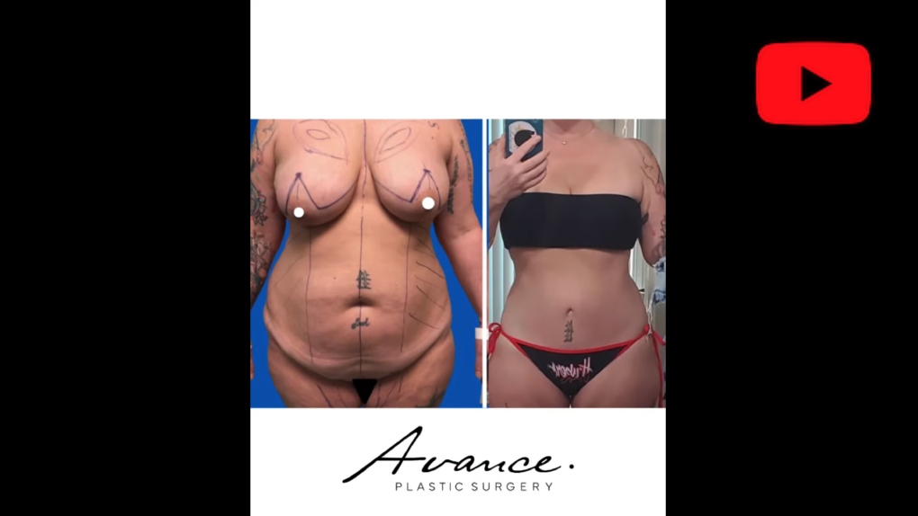 YouTube video titled Reno NV Mommy Makeover Before & After | Dr. Erez Dayan | Avance Plastic Surgery Institute