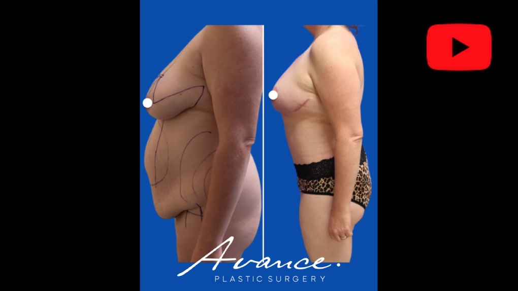 YouTube video titled Reno Mommy Makeover, Tummy Tuck Before and After | Tahoe Breast Lift | Avance Plastic Surgery