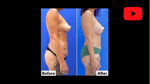 YouTube video titled Incredible Mommy Makeover Result | Avance Plastic Surgery Institute: Dr. Erez Dayan