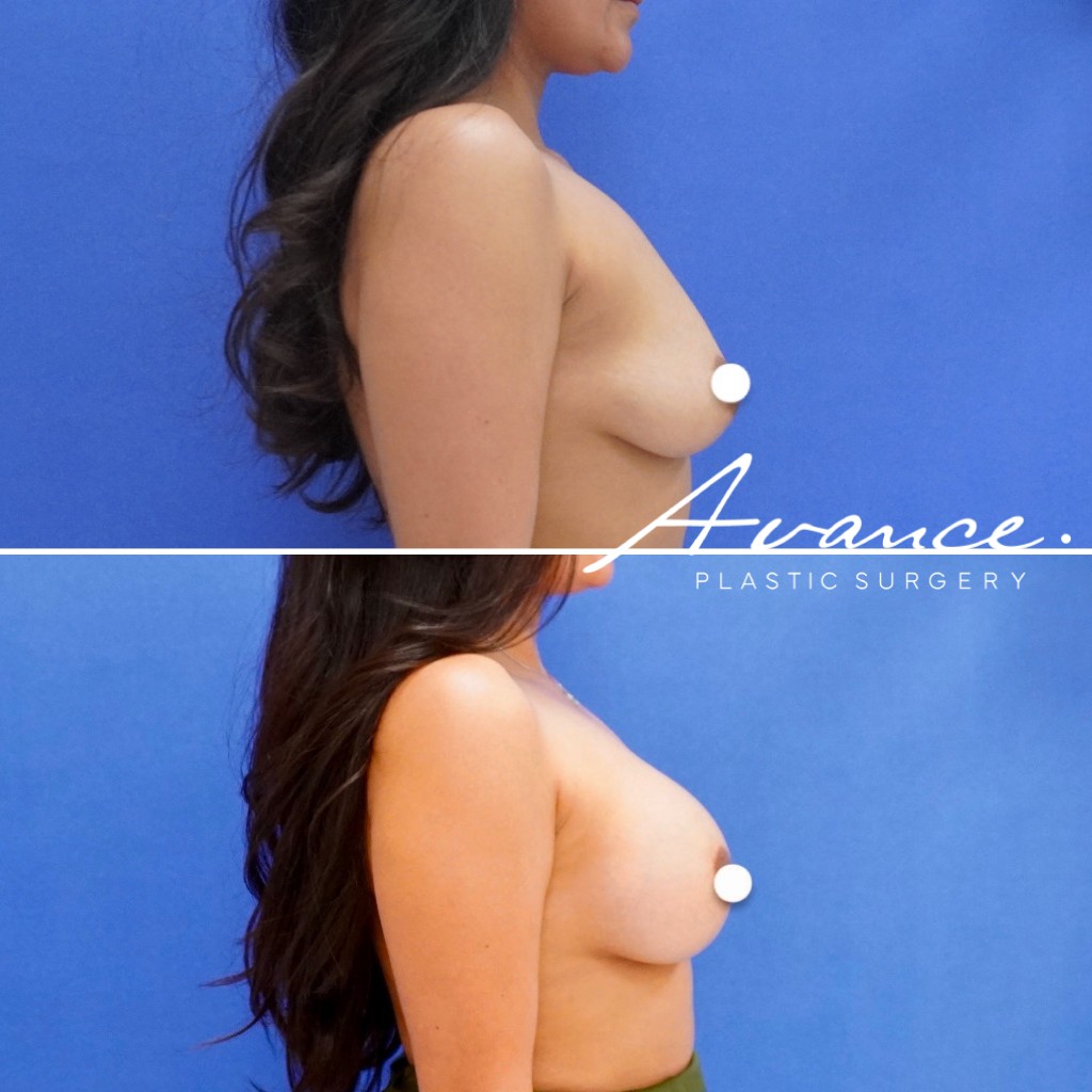 Before and After - Breast Augmentation