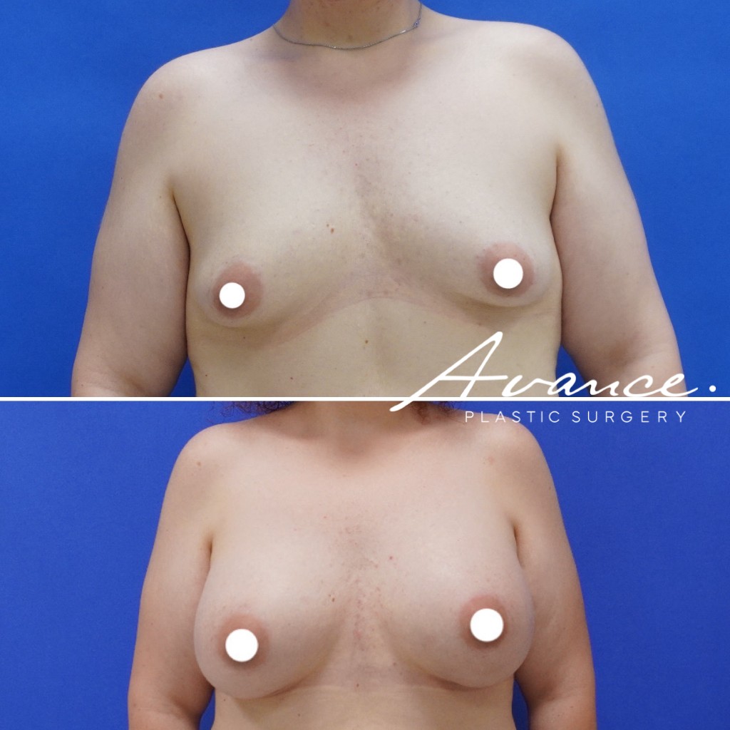 Before and After - Breast Augmentation