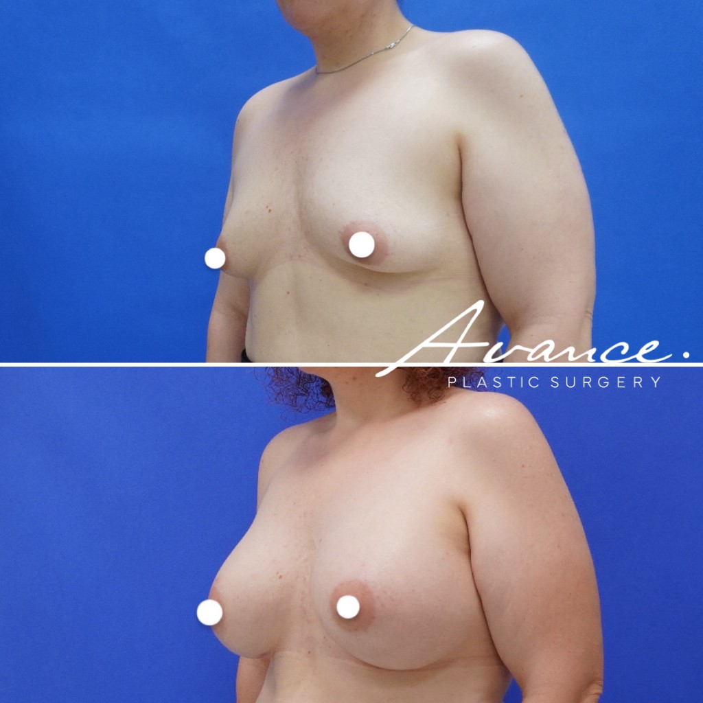 Before and After - Breast Augmentation