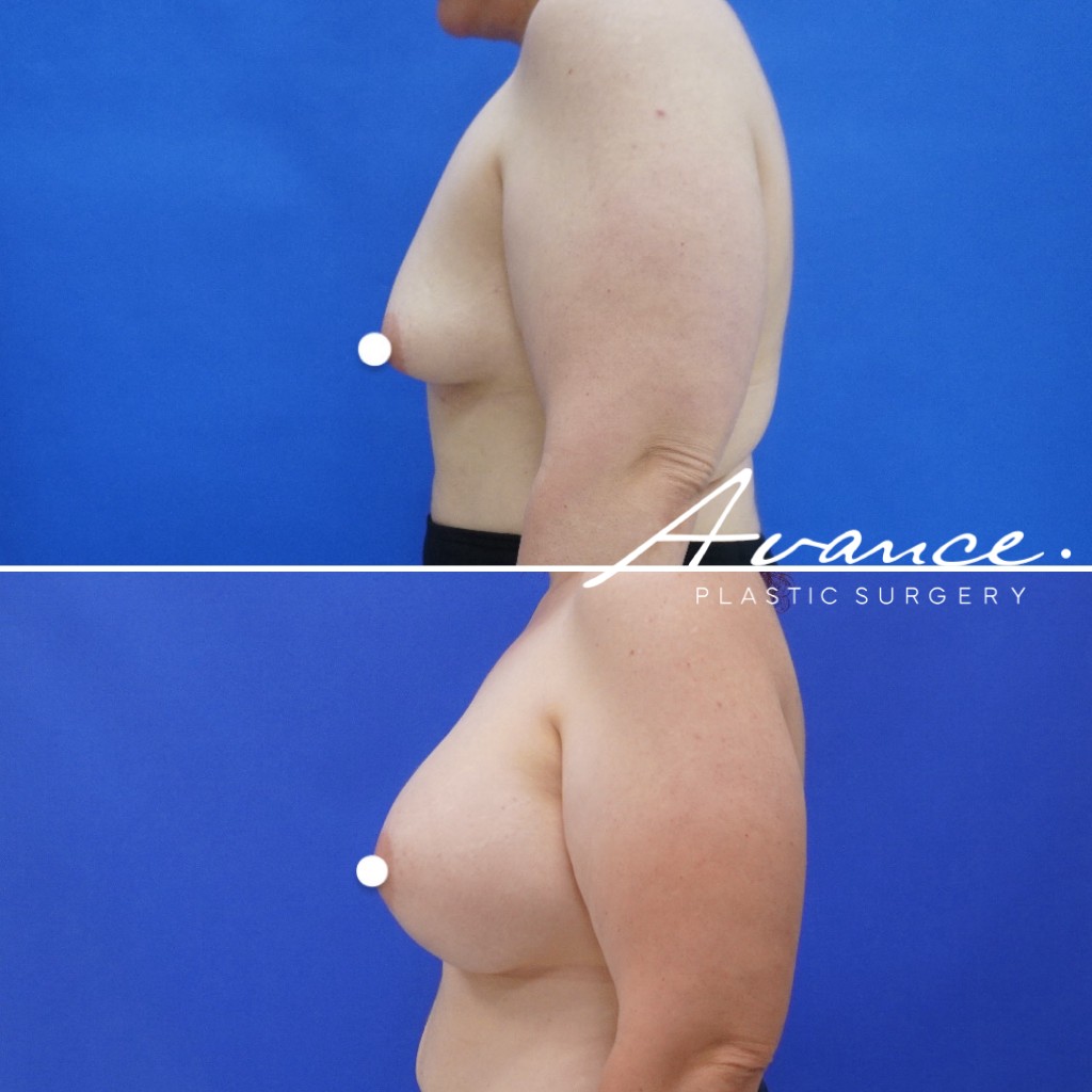 Before and After - Breast Augmentation
