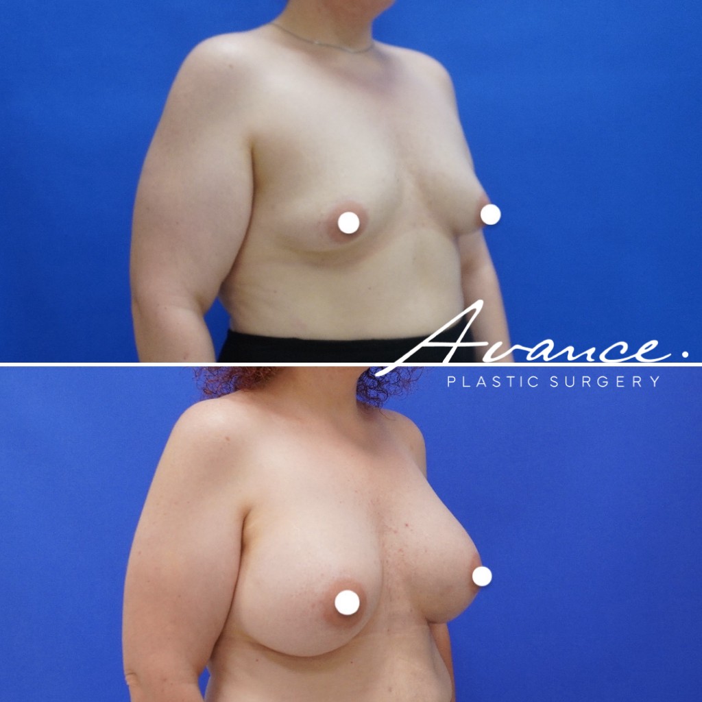 Before and After - Breast Augmentation